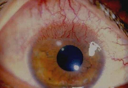 ¿Dónde poder comprar lentillas hidrogel silicona alergia hidrogel de silicona?