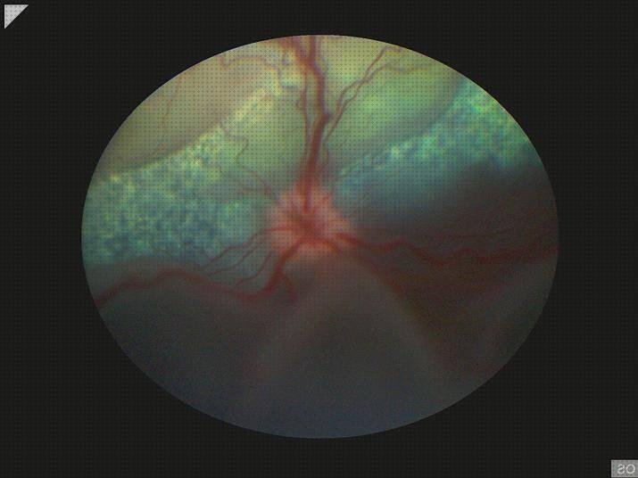 ¿Dónde poder comprar vision con aceite de silicona Más sobre gavetero de plástico Más sobre gavetero de plástico alteración visión por silicona en operación desprendimiento de retina?