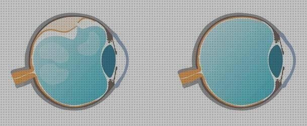 Opiniones de las 1 mejores Alteraciones Visión Por Siliconas En Operaciones Desprendimientos De Retinas