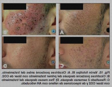 Las mejores bezel metacrilato cortal metacrilato panera metacrilato apl metacrilato