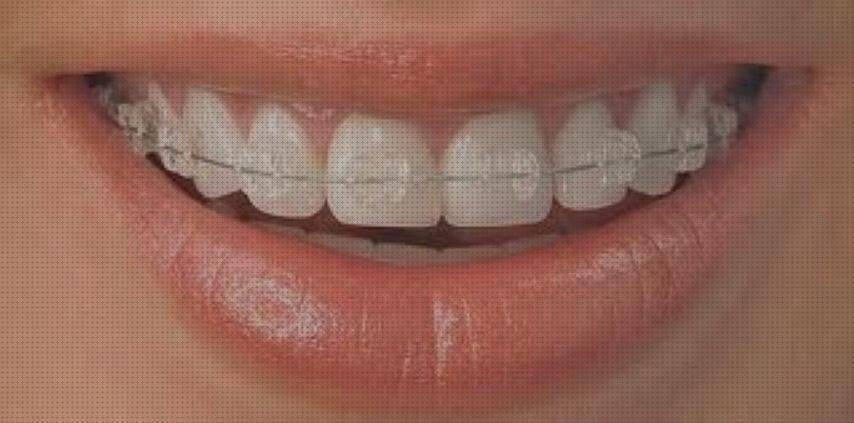 Los 7 Mejores Brackets De Plásticos Transparentes