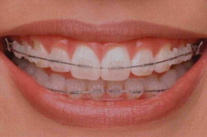 Las mejores marcas de brackets brackets de plastico transparente