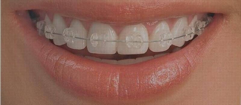 Las mejores brackets brackets de plastico transparente