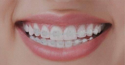 Las mejores brackets brackets esteticos de plastico