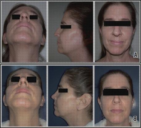 Review de rinomodelacion metacrilato