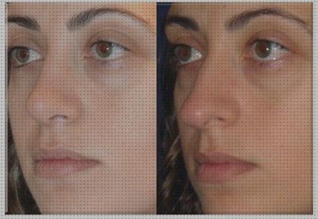 Los 27 Mejores Rinomodelacion Metacrilato